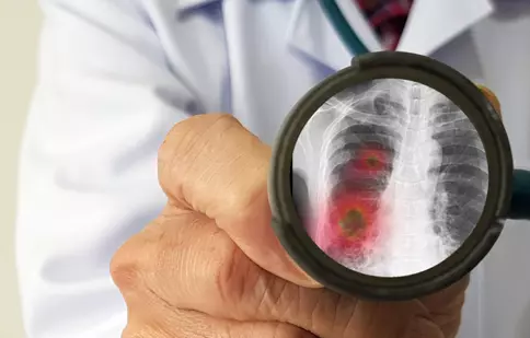 6 cauze comune ale pneumoniei