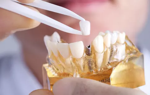 (P) Cum se inseră implantul dentar