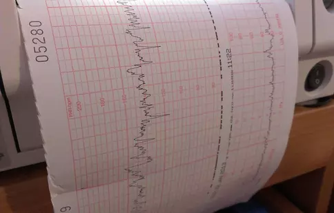 (P) Ecografia Doppler - Ce este și ce afecțiuni neurologice poate depista