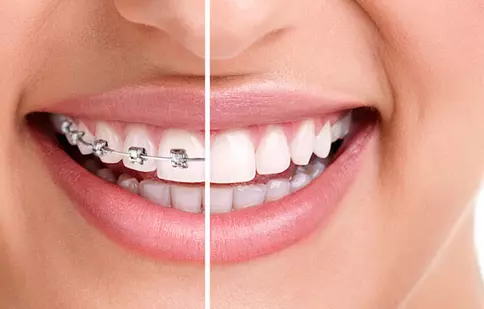 (P) Alege acum un tratament cu aparat dentar si scapa de griji zambind!