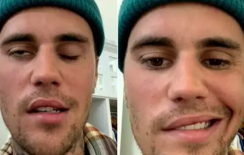 Justin Bieber suferă de paralizie facială cauzată de sindromul Ramsay Hunt. Artistul și-a anulat concertele