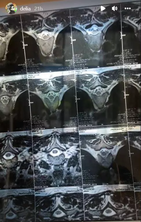 Delia are probleme cu coloana vertebrala