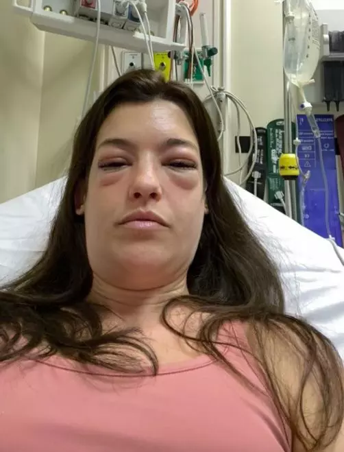 ‘I developed bizarre allergy from pizza – my face swelled so much I could barely see’