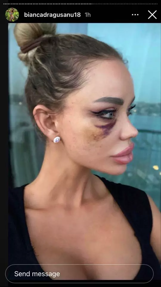 Bianca Drăgușanu, bătută (3)