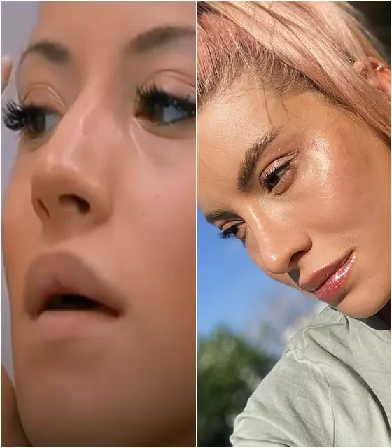 Nicoleta Nucă rinoplastie