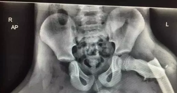 Ce poți păți într-un accident dacă îți ții picioarele pe bord