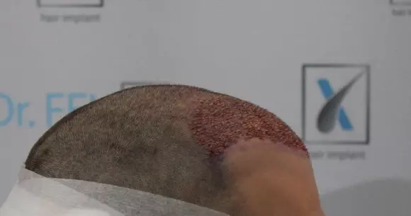 (P) Ești pasionat de mașini, dar îți neglijezi imaginea? Vezi ce presupune un implant de păr