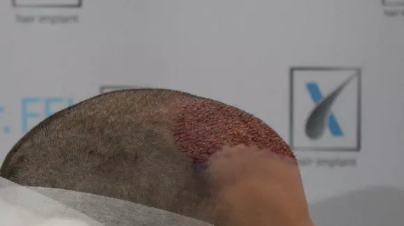 (P) Ești pasionat de mașini, dar îți neglijezi imaginea? Vezi ce presupune un implant de păr