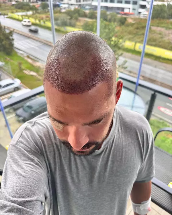 1. Vlad Gherman după implantul de păr