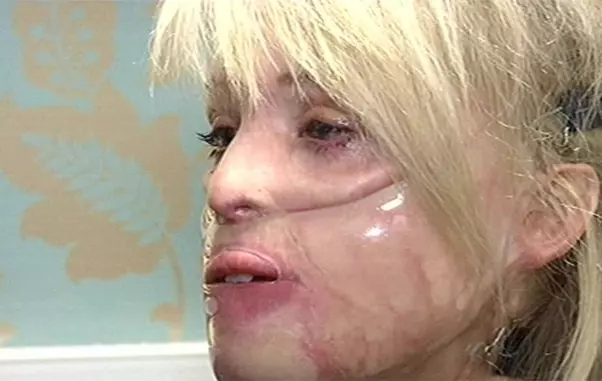 cum-arata-katie-piper-la-12-ani-dupa-ce-chipul-i-a-fost-distrus-cu-acid-sulfuric_6