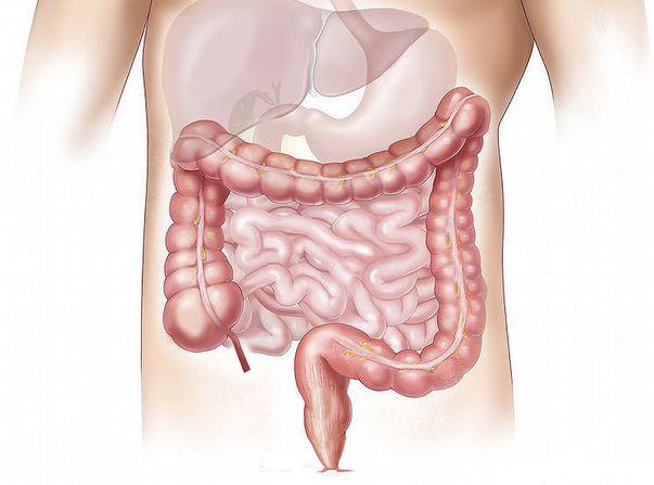 Cancerul Rectal Simptome și Tratament