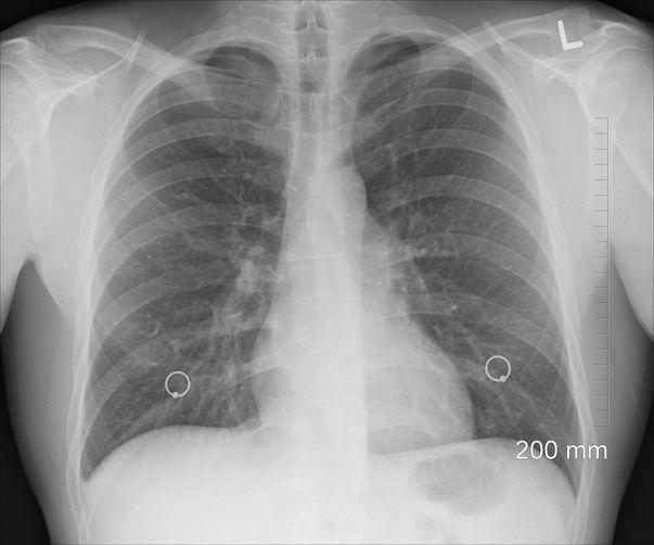 Emfizemul Pulmonar Simptome și Tratament