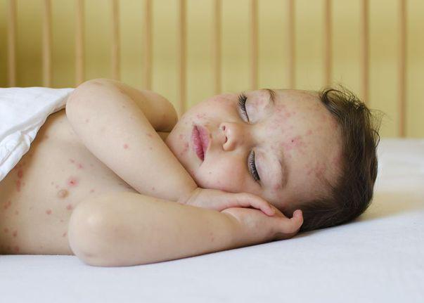 încă Un Copil Nevaccinat A Murit De Rujeolă Județul Fără Cazuri De