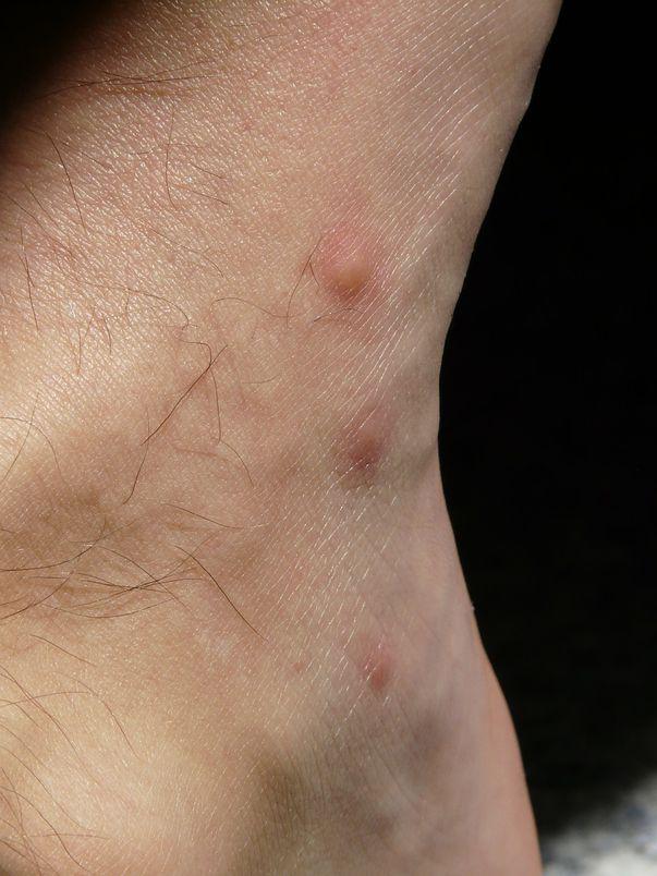 Miliaria Crystallina Simptome și Tratament