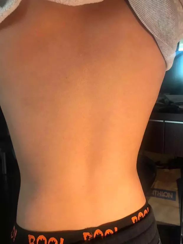 O mama a surprins diferenta dintre manifestarile varicelei cu si fara vaccin (3)