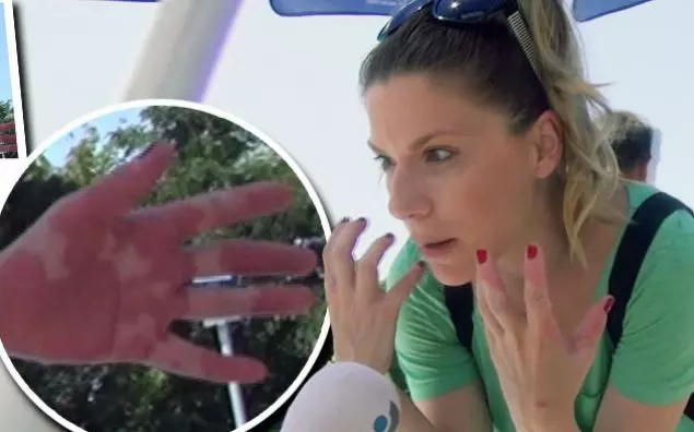 Tilly Niculae are psoriazis