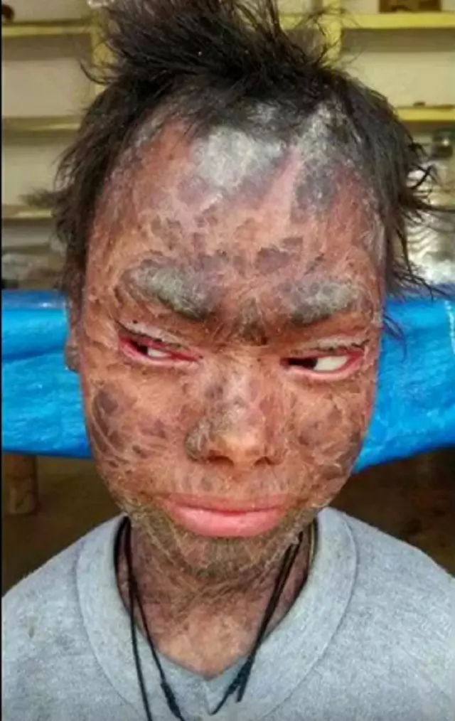 O tânără trece prin probleme grave cu pielea sa