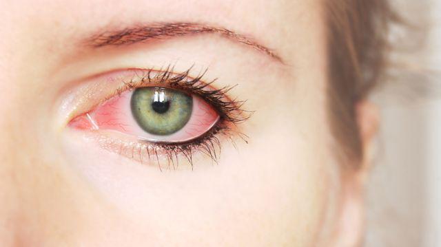 dureri articulare ochi roșii Vyprosal pentru dureri articulare