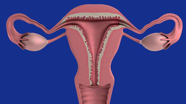 Cancerul Ovarian Simptome și Tratament