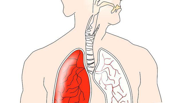 Cancerul pulmonar: cel mai mortal tip de cancer din lume | rogather.ro