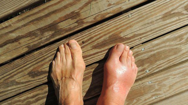 Durerea de picioare in artita reumatoida