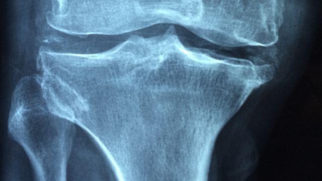osteonecroza spontană a tratamentului articulației genunchiului gonartroza de gradul 1 al articulației genunchiului