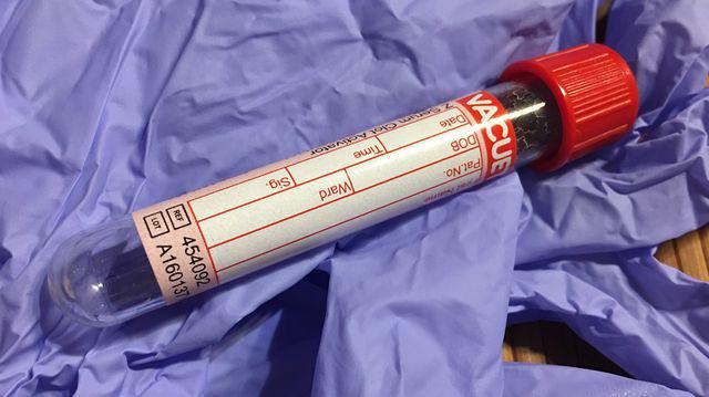 Anemia Prin Deficit De Vitamine Simptome și Tratament