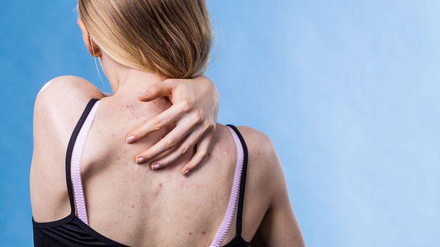 Acneea Pe Spate și Pe Piept De Ce Apare și Cum Poate Fi Prevenită