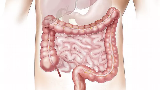 cancerul de colon simptome si tratament