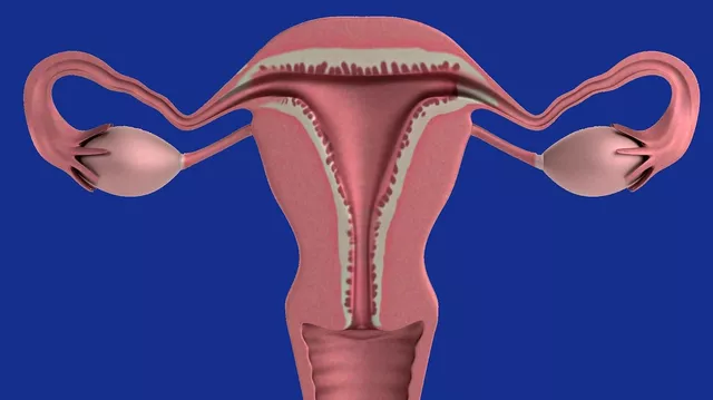 cancerul ovarian simptome sarcini solitare zilnice