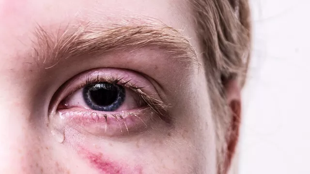 infectie la ochi tratament