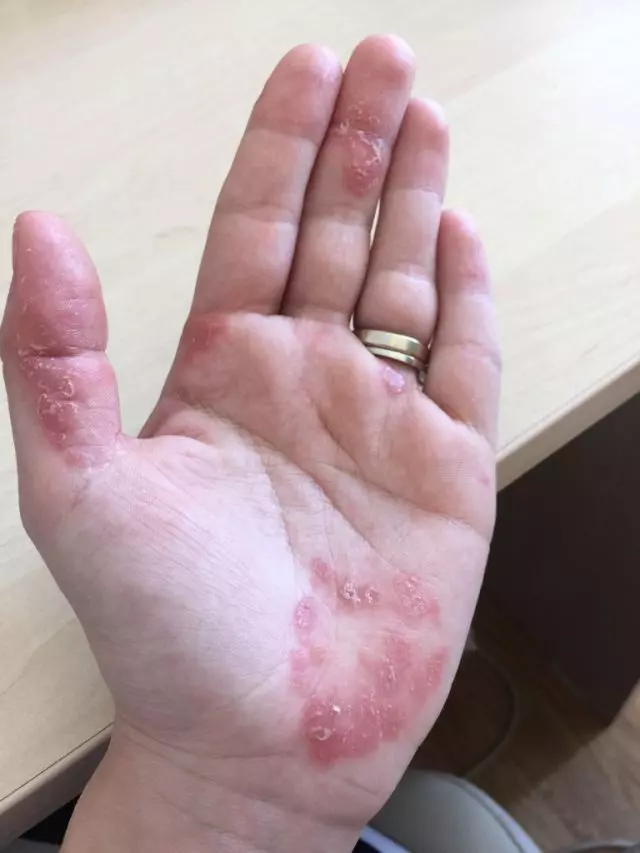 Tilly Niculae are psoriazis