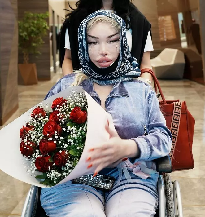 *EXCLUSIVE* WEB MUST CALL FOR PRICING  - Former Celebrity Big Brother star Jessica Alves is pictured with some heavy bandaging while leaving Trio plastic surgery clinic in Istanbul after undergoing her 5th facelift after dissolving face fillers!!