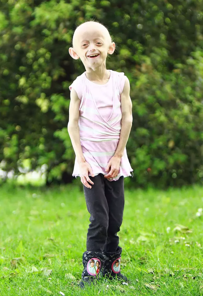 progeria6.jpg