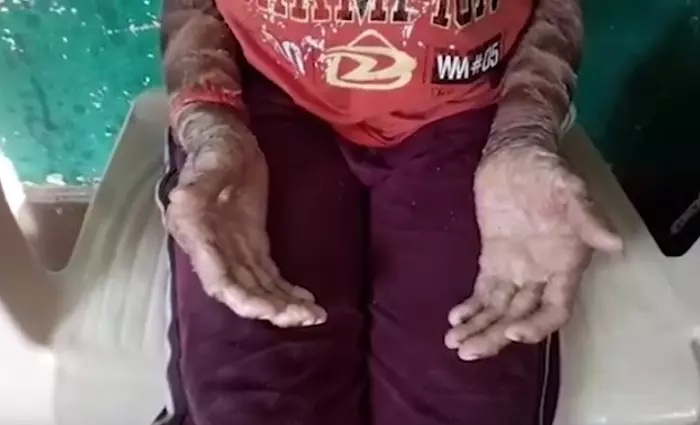 O tânără trece prin probleme grave cu pielea sa