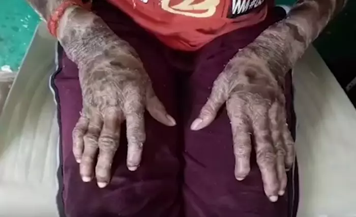 O tânără trece prin probleme grave cu pielea sa