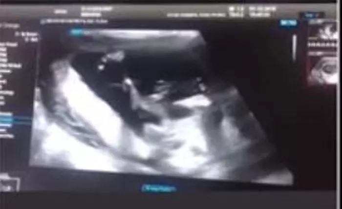 Prima ecografie cu bebelușul lui Catrinel Menghia