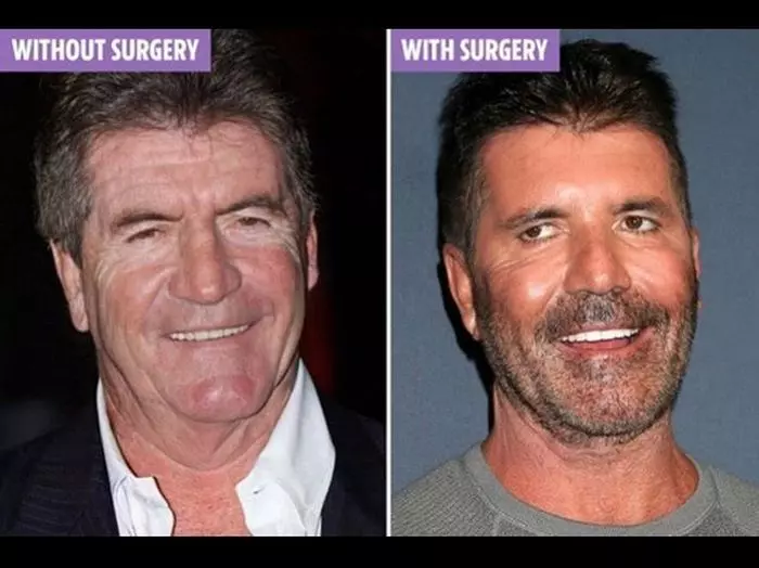 Simon Cowell, înainte și după operațiile estetice, conform unei simulări computerizate.