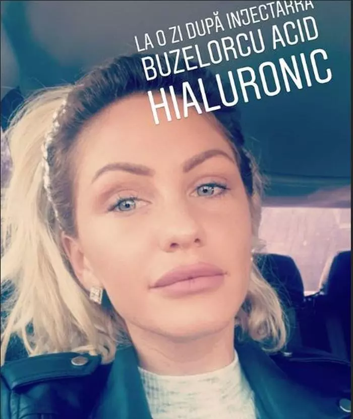 Hannelore și-a mărit buzele