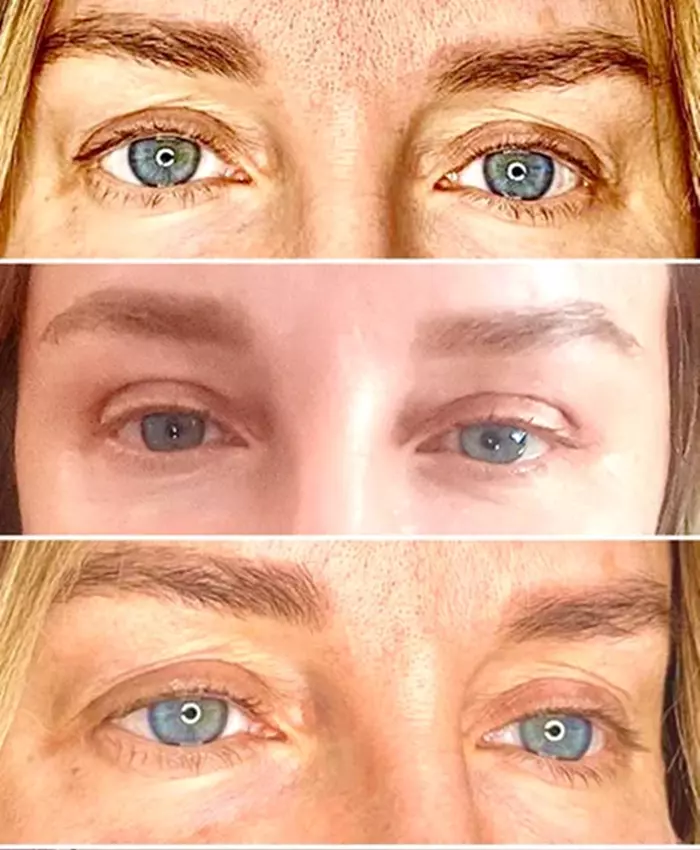 Tania Budi blefaroplastie