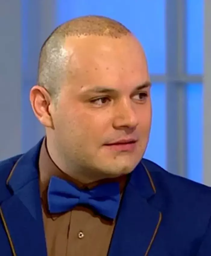 Raoul implant păr