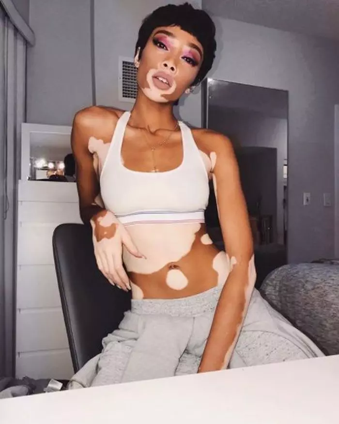 Winnie Harlow, cel mai frumos model cu vitiligo