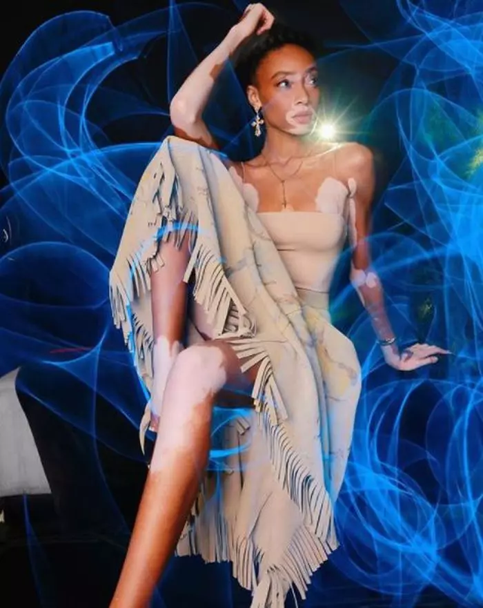 Winnie Harlow, cel mai frumos model cu vitiligo