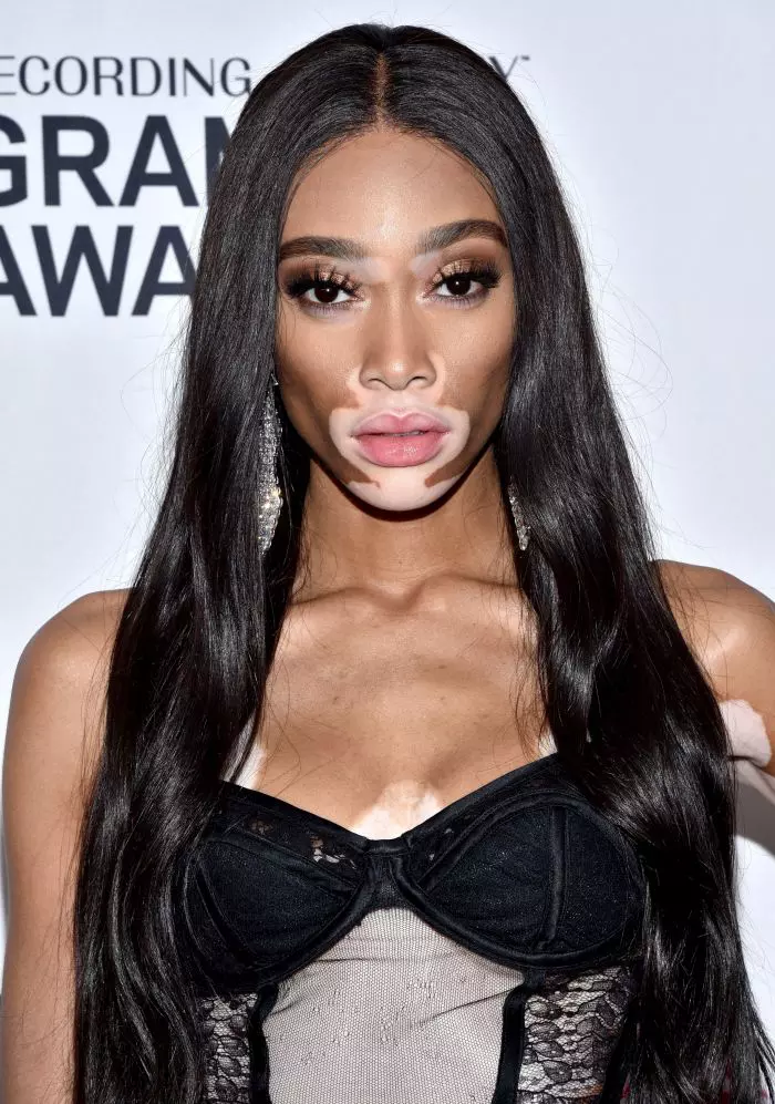 Winnie Harlow
