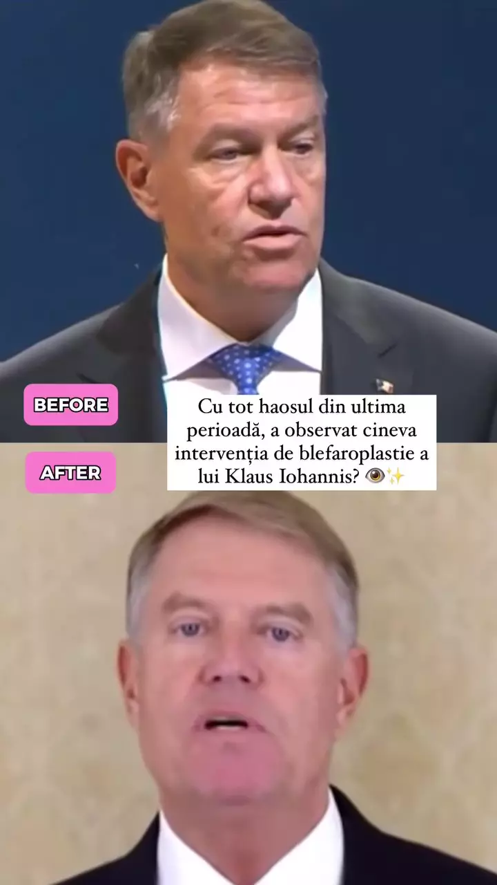 Klaus Iohannis și-ar fi făcut o blefaroplastie (1)
