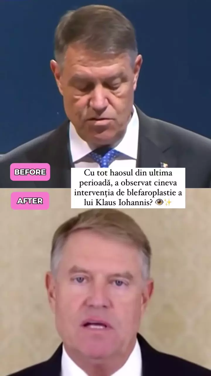 Klaus Iohannis și-ar fi făcut o blefaroplastie (2)