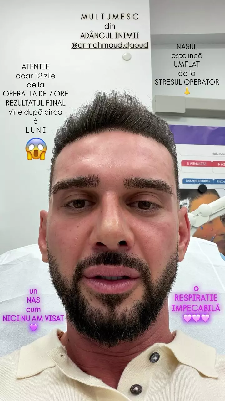 Dorian Popa după operația la nas (2)