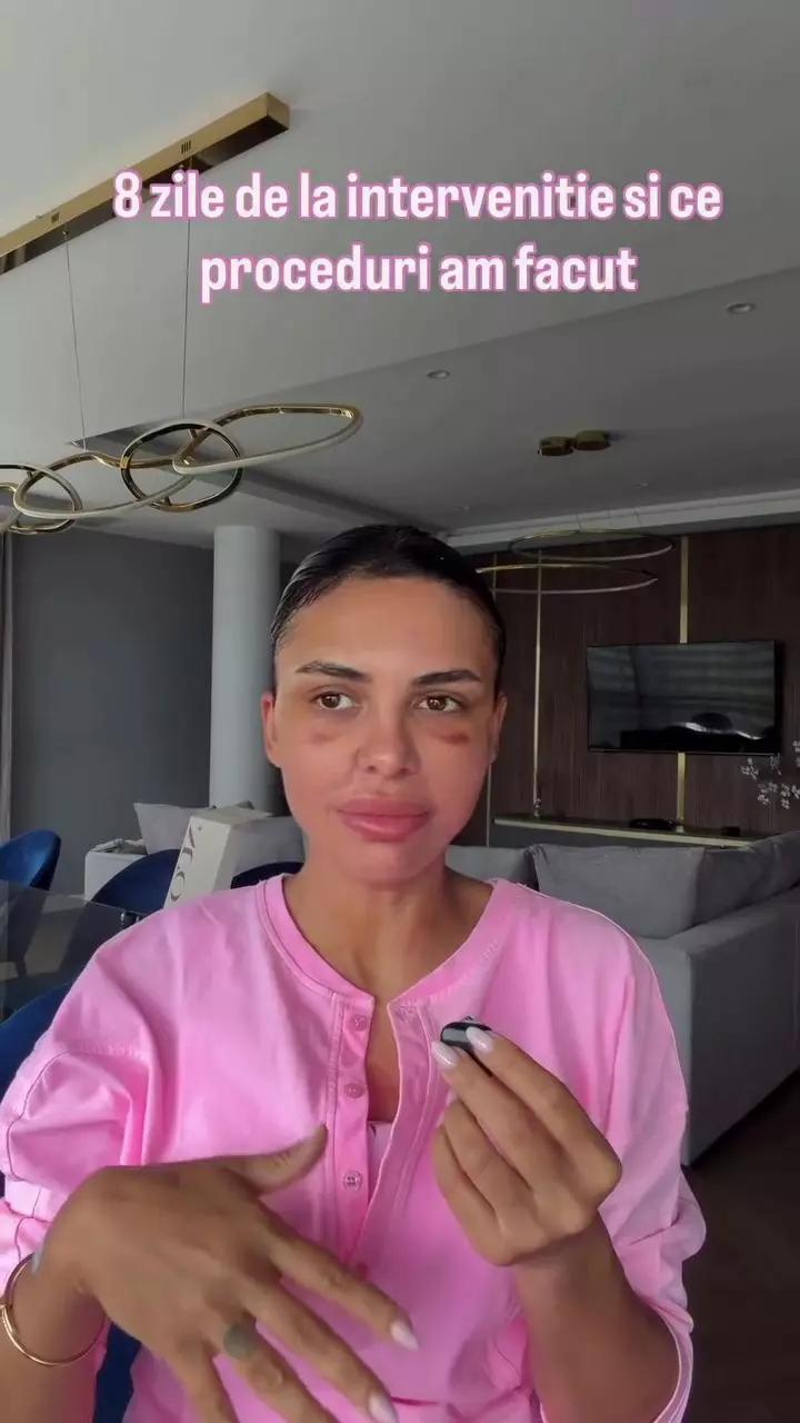 Andreea Popescu după eyebrow lift (1)