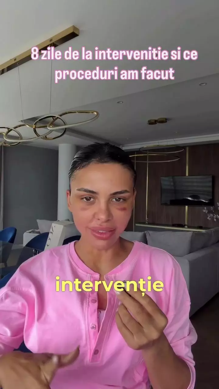 Andreea Popescu după eyebrow lift (2)