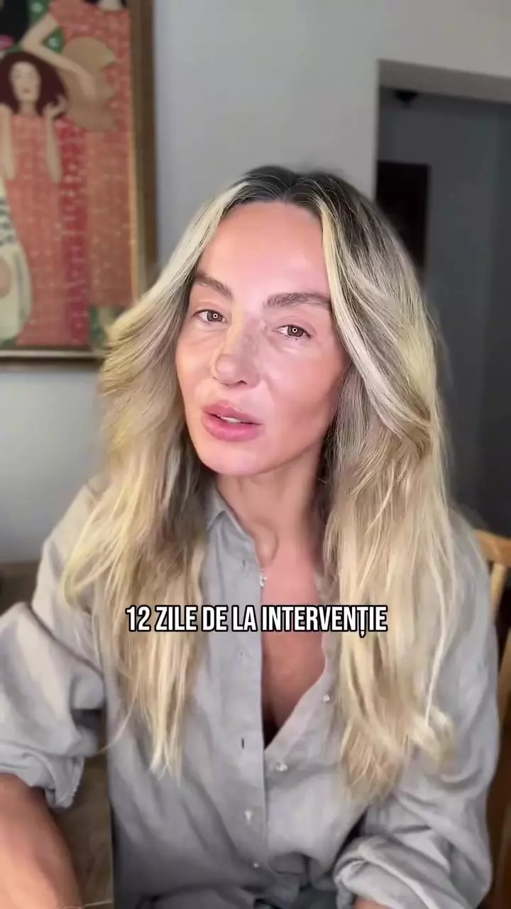 Flavia Mihășan după operația la nas (7)